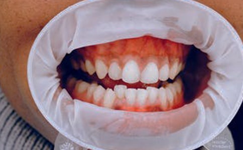 口腔執(zhí)業(yè)助理醫(yī)師考點(diǎn):正常牙齦臨床解剖說明